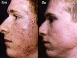 face acne scar removal
