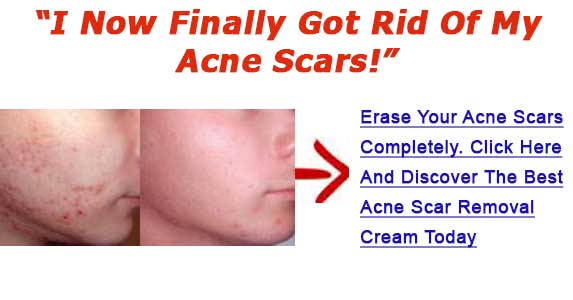 best acne scar fading cream