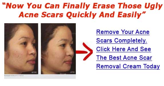 removal of pimple scars
