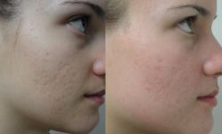 removal of pimple scars